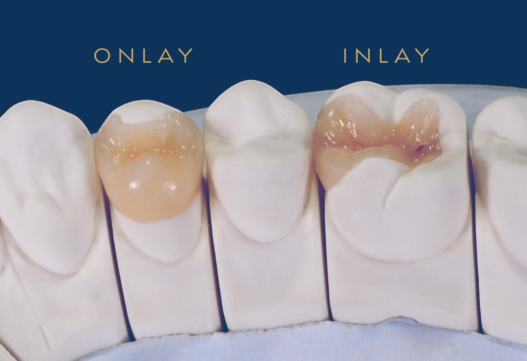 Inlay Onlay Blackburn Mill Hill Dental Blackburn